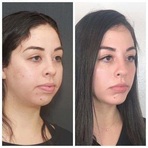 buccal fat removal without surgery